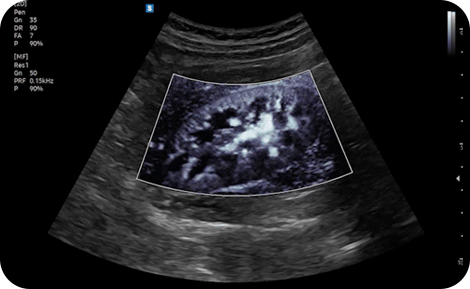 Ecografia renale - immagine ecografica dei reni